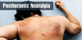 KNOW ABOUT POSTHERPETIC NEURALGIA IN A NUTSHELL