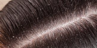 Dandruff- Causes and Symptoms