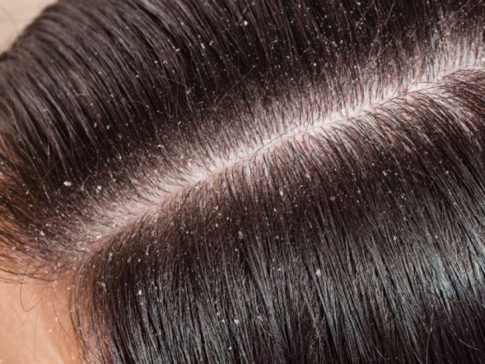 Dandruff- Causes and Symptoms