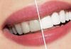 teeth whitening in dubai