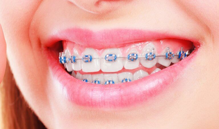 dental braces in dubai abu dhabi