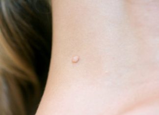 Skin Tags Removal london