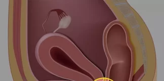 vaginal fistulas
