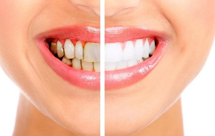 teeth whitening services