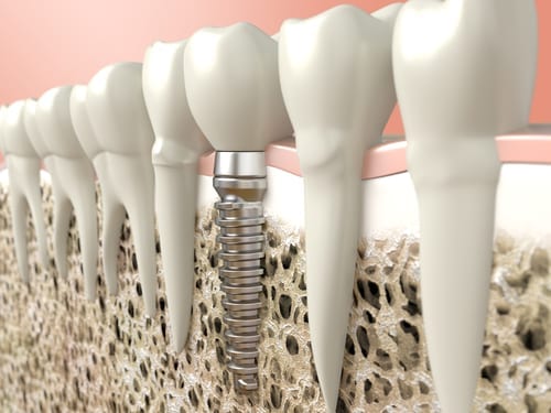 Dental Implants cost